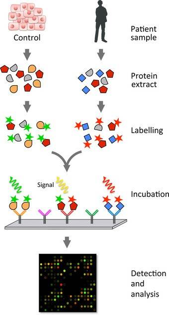 Workflow of an analysis by antibody microarray of the protein content of a patient sample.
