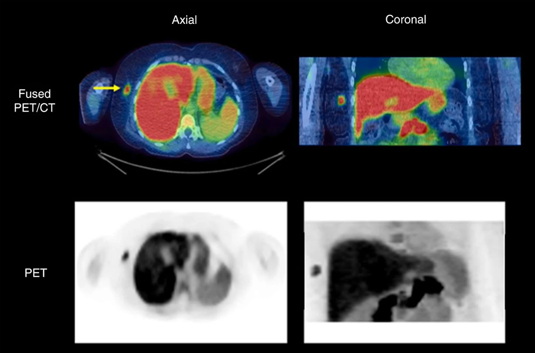Summed 5- to 10-min dynamic 18F-fluciclovine PET and fused PET/CT images of a patient with oestrogen receptor-positive IDC.