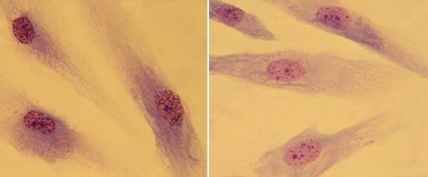 UV-induced DNA repair synthesis on autoradiographic preparations of primary dermal fibroblasts irradiated with UV light and incubated with 3H-thymidine.